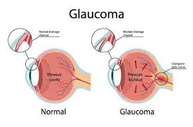 glaucoma 2